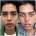 Before and after rejuvenation with own stem cells, facial skin improvement results