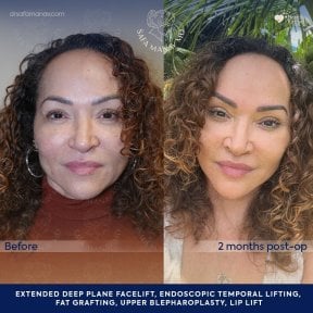before-after photo deep-plane-facelift
