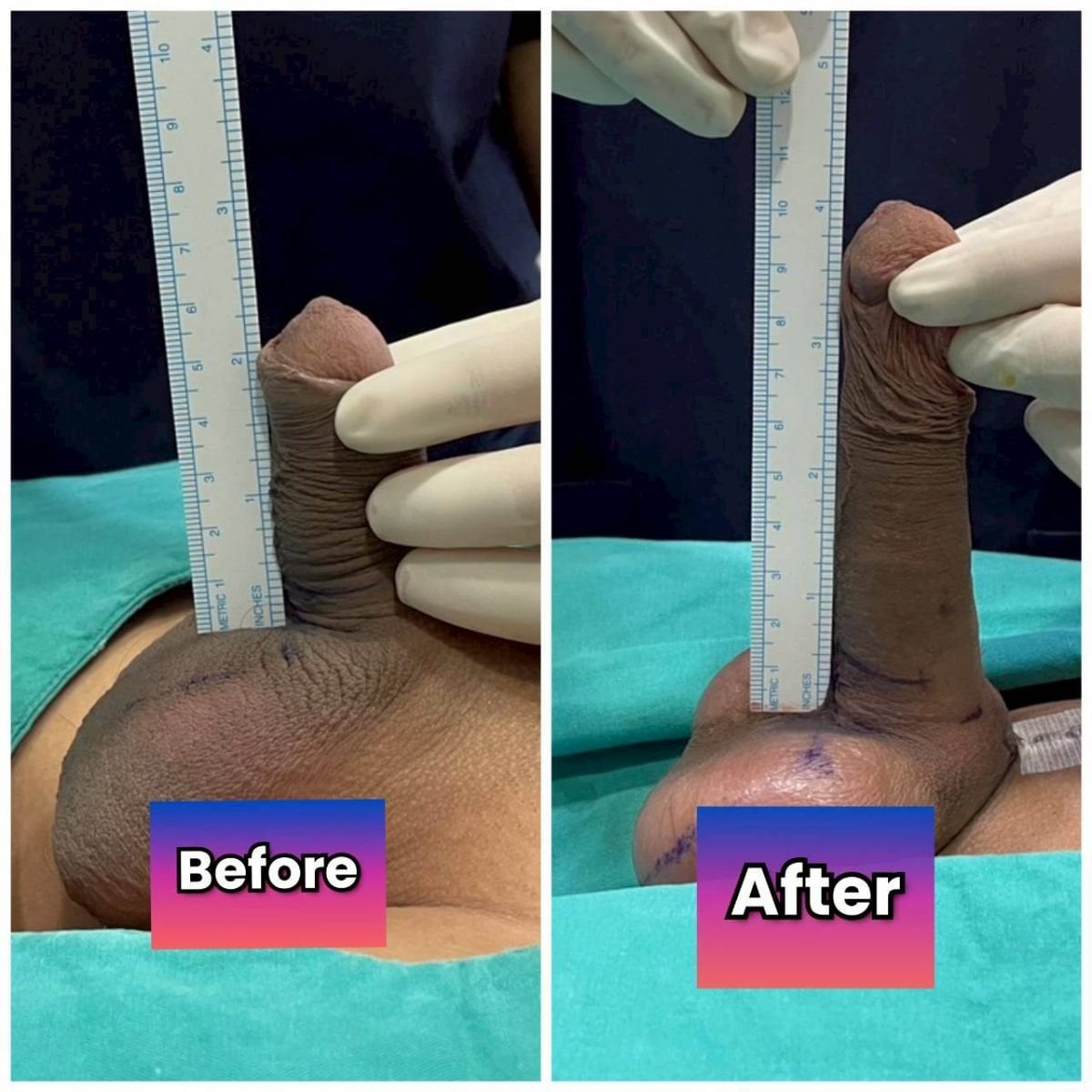 Resultados antes y después de alargamiento de pene quirúrgico en Eternity Clinic Phuket By Dr.Beer