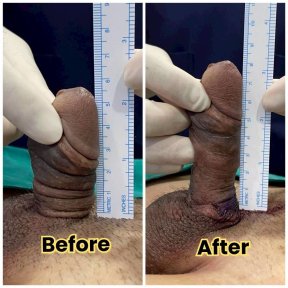 before-after photo surgical-penile-lengthening