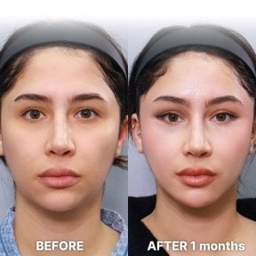 before-after photo blepharoplasty-eyelid