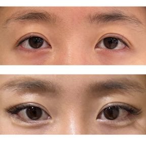 before-after photo blepharoplasty-eyelid