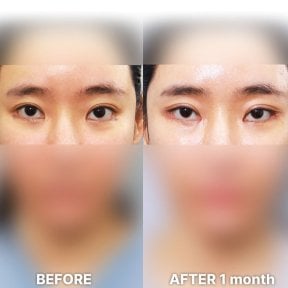 before-after photo blepharoplasty-eyelid