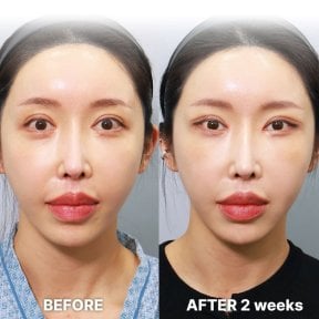 before-after photo blepharoplasty-eyelid