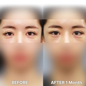 before-after photo blepharoplasty-eyelid