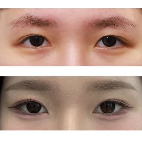before-after photo blepharoplasty-eyelid