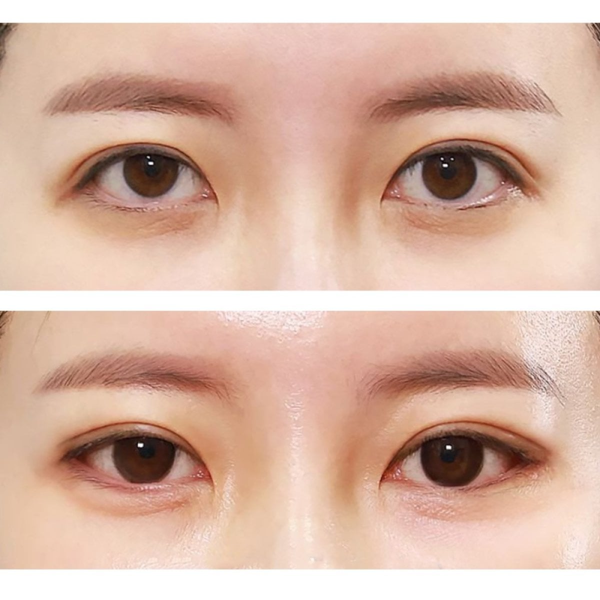 Resultados de blefaroplastia antes y después en Returning Plastic Surgery, corrección de párpados