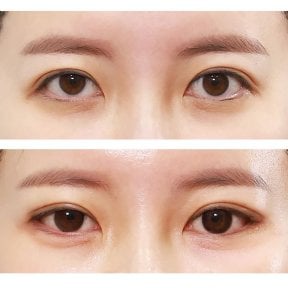 before-after photo blepharoplasty-eyelid