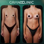 Результаты до и после увеличения груди в Grand Clinic, улучшенная форма и размер груди