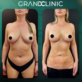 Результаты до и после увеличения груди в Grand Clinic, улучшенная форма и контур груди