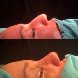 Before and after rhinoplasty results, nose reshaping with improved profile and contour