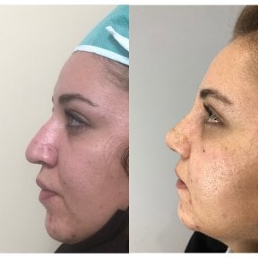 Before and after rhinoplasty results, nose reshaping with improved profile and contour