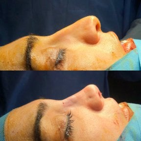 Before and after rhinoplasty results, nose reshaping with improved profile and contour