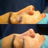 Before and after rhinoplasty results, nose reshaping with improved profile and contour
