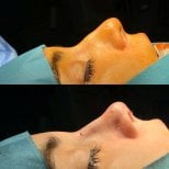 Before and after rhinoplasty results – nose reshaping with improved nasal profile