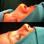Before and after rhinoplasty results, visible nose reshaping and profile improvement