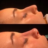 Before and after rhinoplasty results, visible nose reshaping and profile improvement