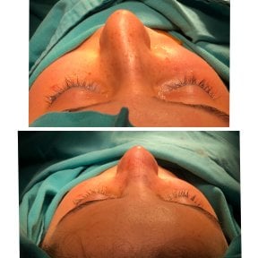 Before and after rhinoplasty results, nose reshaping with improved contour and symmetry