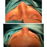 Before and after rhinoplasty results, nose reshaping with improved contour and symmetry
