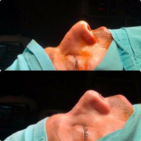 Before and after rhinoplasty results, improved nose shape and profile after surgery