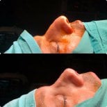 Before and after rhinoplasty results, improved nose shape and profile after surgery