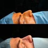Before and after rhinoplasty results – improved nose shape and profile after surgery