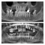 Before and after dental implant results at Spanderashvili Dental Clinic, improved jaw structure