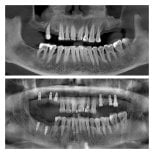 Before and after dental implant results at Spanderashvili Dental Clinic, improved jaw structure