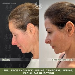 before-after photo deep-plane-facelift