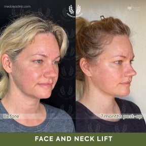 before-after photo deep-plane-facelift