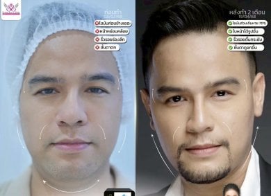 Before and after brow lift results at Somchai Clinic, visible lifted brow and youthful look