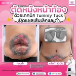 Результаты абдоминопластики в клинике Somchai – плоский живот через 10 дней