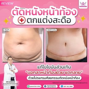 Результаты липосакции живота до и после в клинике Somchai – более плоский живот