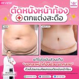 Результаты липосакции живота до и после в клинике Somchai – более плоский живот