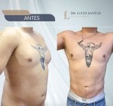 Результаты до и после операции гинекомастии в Lucio Santos Plastic Surgery, коррекция груди