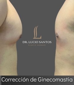 Результаты до и после операции по гинекомастии в Lucio Santos Plastic Surgery, контур груди