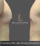 Результаты до и после операции по гинекомастии в Lucio Santos Plastic Surgery, контур груди