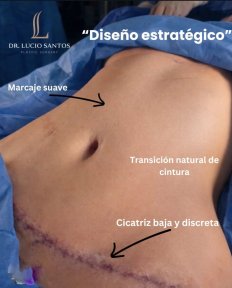 Résultat de liposuccion chez Lucio Santos Plastic Surgery : taille affinée et cicatrice discrète