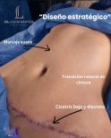 Résultat de liposuccion chez Lucio Santos Plastic Surgery : taille affinée et cicatrice discrète