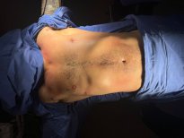 Résultat de liposuccion chez Lucio Santos Plastic Surgery, contour abdominal masculin amélioré
