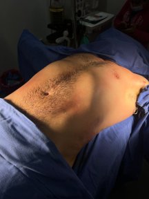 Résultat de liposuccion chez Lucio Santos Plastic Surgery, amélioration du ventre masculin