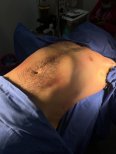 Résultat de liposuccion chez Lucio Santos Plastic Surgery, amélioration du ventre masculin