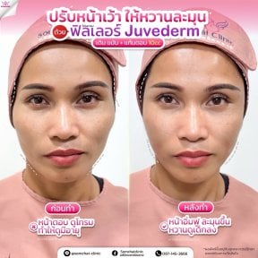 Before and after fillers injection at Somchai Clinic, Juvederm for facial contour enhancement result