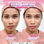 Before and after fillers injection at Somchai Clinic, Juvederm for facial contour enhancement result