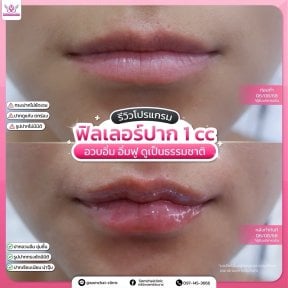 Before and after lip fillers injection result at Somchai Clinic – fuller, natural-looking lips