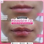 Before and after lip fillers injection result at Somchai Clinic – fuller, natural-looking lips