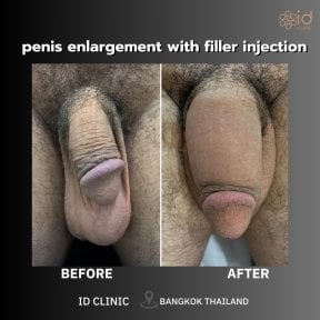 before-after photo hair-transplant