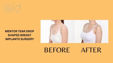 before-after photo breast-augmentation-with-silicone-implants
