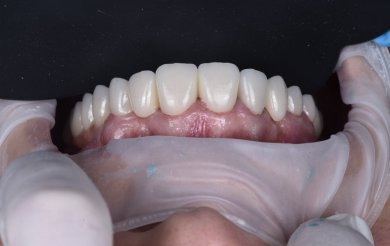before-after photo dental-implant