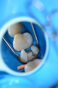 before-after photo dental-implant